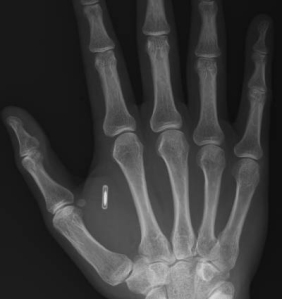 Human_chip_RFID_In_Hand